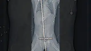 Scary Survival: Impaled Man Experiences A Miracle #shorts