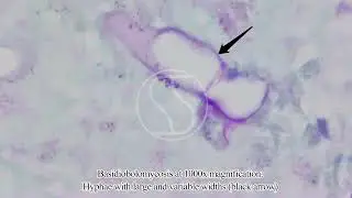 Basidiobolomycosis with McManus&rsquo; PAS Stain
