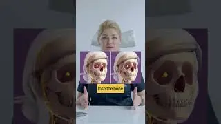 Is our bone shrinking?#aging #antiaging #facialstructure #cosmeticdermatologist#juvederm #voluma