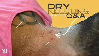 The Expert Guide to Dry Needling | Q&A With a Dry Needling Specialist