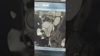 MRI placenta #mri #beginners #mritech #anatomy #like #subscribe #featus
