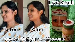 Wart Remover Honest Review in Tamil | வலியே இல்லாமல் மருவை நிரந்தரமாக நீக்கலாம் | Wart Remover Tamil