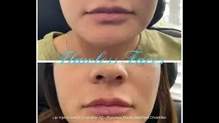 Lip injections in Chandler AZ - Flawless Faces MedSpa Chandler