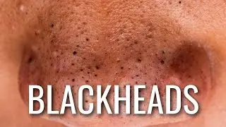 Here’s HOW To Stop Getting Blackheads