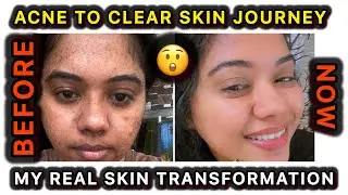 🤩எப்படி எனக்கு முகப்பரு குறைந்து?| How I Got Clear Skin | My Night Skincare Routine for Acne & Glow 