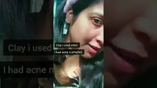 best clay mask  for oily/acne prone skin 😍#short #viral #youtubeshorts #shorts #pimples #oilyskin