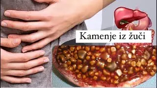 ŽUČNI KAMENAC IZBACITE KROZ STOLICU NA OVAJ NAČIN SAVETUJE KINESKI DOKTOR (recept i primena)