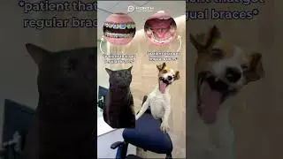Team conventional braces or lingual braces? #bracesjourney #braces #dentalbraces #orthodontics
