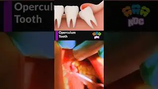 Operculum wisdom tooth treatment #dentist #dentistry #wisdomtooth #shortsfeed