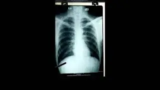 Normal Chest X-ray P/A view.
