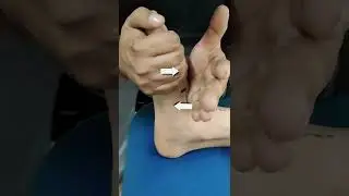 MOBILIZATION THERAPY FOR FLAT FOOT / MEDIAL ARCH PAIN.