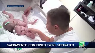 'Really happy babies': Sacramento twins conjoined by heads successfully separated