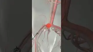 Узнайте, как работает катетеризация сердца