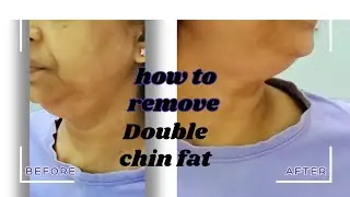 How to remove double chin fat too fast
