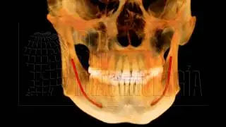 CONDUCTO DENTARIO INFERIOR Y AGUJERO MENTONEANO