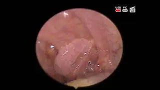 left palatine tonsil #papilloma radio wave #surgery otolaryngology head neck #oncology Kyiv Ukraine