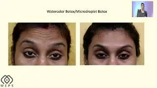 AIOS2025 IC25 T Dr Adit GUPTA Botox For Pericular Rejuvenation