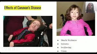 Capstone Canavan's Disease