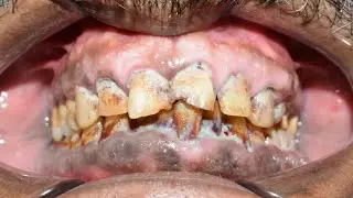 Don&rsquo;t LOSE *All* Of Your TEETH To GUM DISEASE