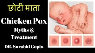 Chicken Pox  Symptoms, Treatment, Prevention, Myths & complications