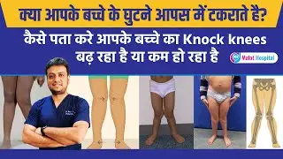 क्या आपके बच्चे के घुटने आपस में टकराते है? | बच्चों में नौकनी (Knock Knees) का इलाज और निदान