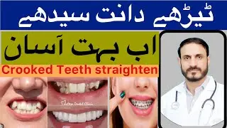 Crooked Teeth Best Solution | Braces Treatment for Perfect Smile.