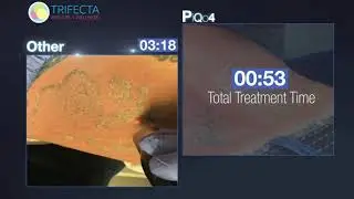 PiQo4 Tattoo Removal Laser Comparison NYC