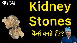 Kidney Stones कैसे बनते हैं? How Kidney stones are formed??  (In Hindi) Kidney Stone Treatment
