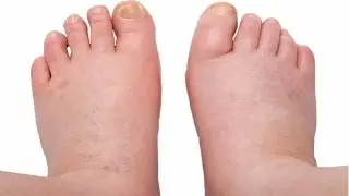 Home Remedies For Feet And Ankle Swelling