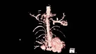 MRI thoracic duct imaging for primary lymphedema patients -lymphedema surgery in Japan-