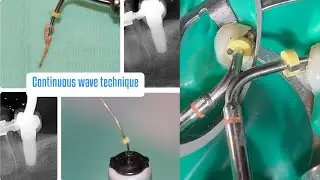 Continuous wave of condensation step by step lower premolar