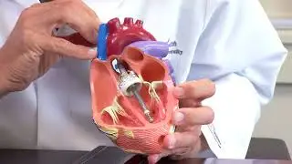 IMPELLA 5.5: WORLD&rsquo;S SMALLEST HEART PUMP GETS EVEN BETTER!