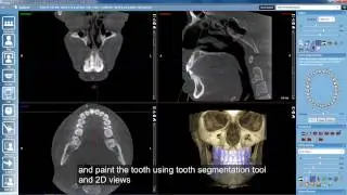Planmeca Romexis &ndash; Segmenting roots and bone surface for orthodontic treatment planning