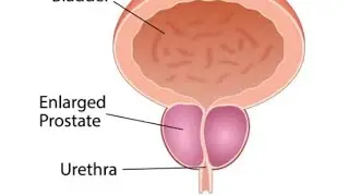 Acupressure points for prostate enlargement