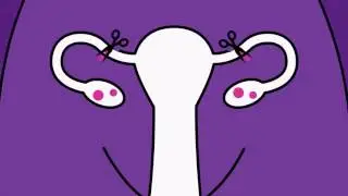 Brook Contraception - Sterilisation Animation