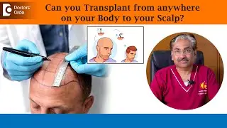 Beard or Body Hair to Scalp | BODY HAIR TRANSPLANT for Baldness-Dr.Venkataram Mysore|Doctors' Circle