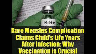 Rare Measles Complication Claims Child&rsquo;s Life Years After Infection: Why Vaccination is Crucial