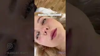 Увеличение губ в авторской технике &laquo;Natural lips&raquo; и повторная коррекция через 6 мес. LL BEAUTY.