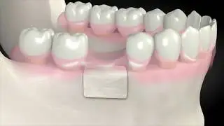 Bone Grafting Purpose & Benefits (2017 TV SEGMENT)