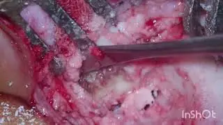 Pt. Name-mojibur rahman age-14 left ear mastoid with severe candective hearing loss 