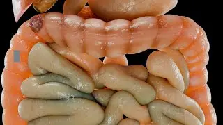 Personalized chemotherapy guided by ctDNA refines post-surgery colon cancer care
