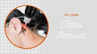 Pico Laser Tattoo Removal | VIP Laser | Miami