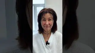 Как вам преображение? 😍 Фейслифтинг. Верхняя блефаропластика. Доктор КОЗЬМЕНКО ИРИНА