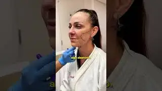 Sculptra na pr&aacute;tica: Veja como &eacute; a aplica&ccedil;&atilde;o do bioestimulador! 💉 #sculptra #drfabiosaito