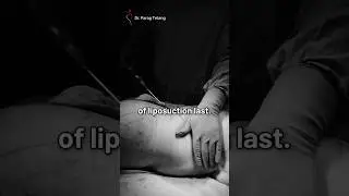 How Long Does Liposuction Last?   #shorts  #liposuction #fatloss