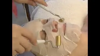 Facelift Galvanic Current Treatment