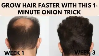 Onion + Oil Overnight Hack for Hair Growth