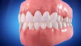 Invisalign- how does it work video. Now at Elite Dental Care