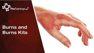 Burns and Burns Kits