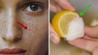 Want to Remove Freckles?  | Best Home Remedies to Get Rid of Freckles